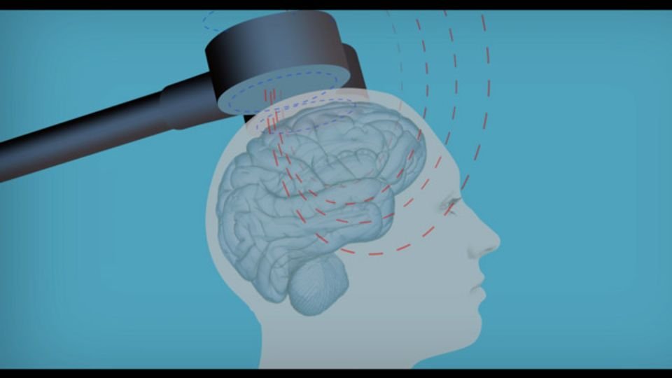 Illustration of Transcranial Magnetic Stimulation (rTMS), showing a magnetic pulse being directed at the brain to help with mental health treatments.